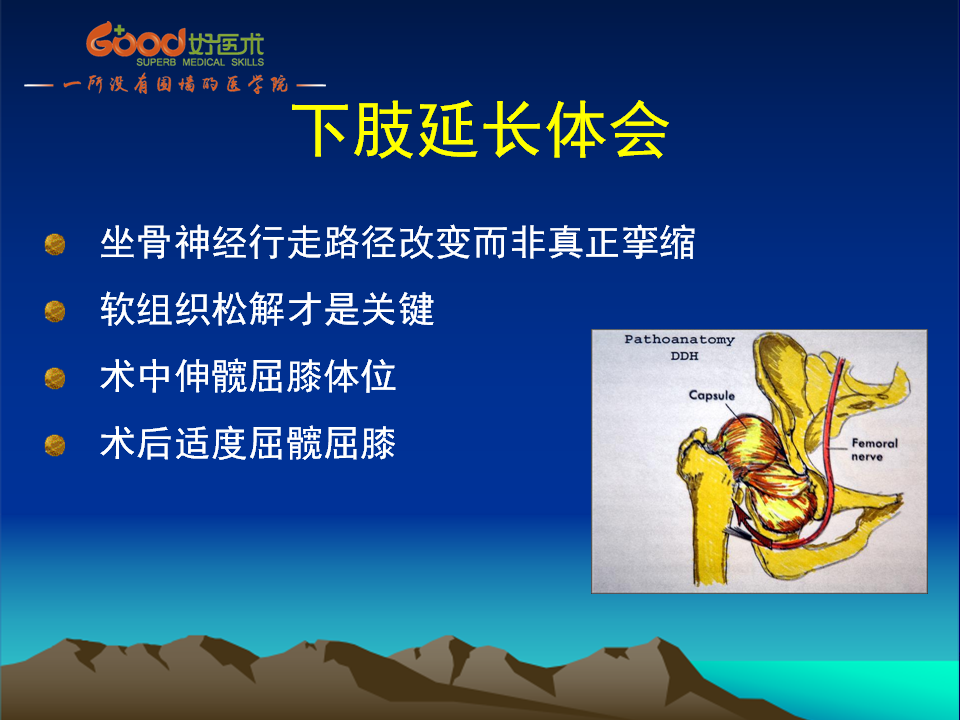 髋臼发育不良(DDH)手术策略