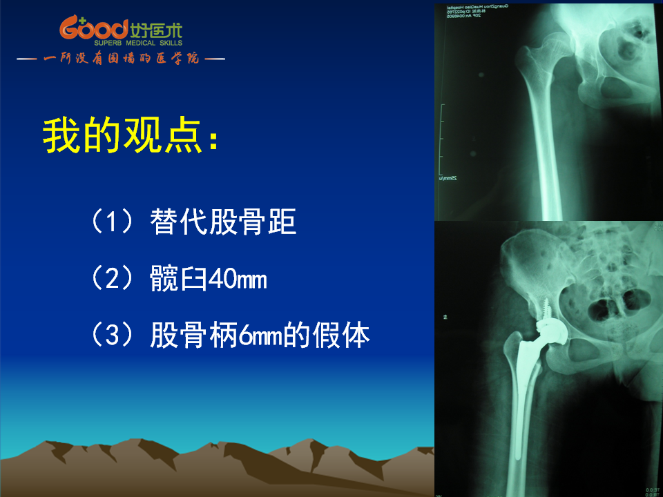 髋臼发育不良(DDH)手术策略