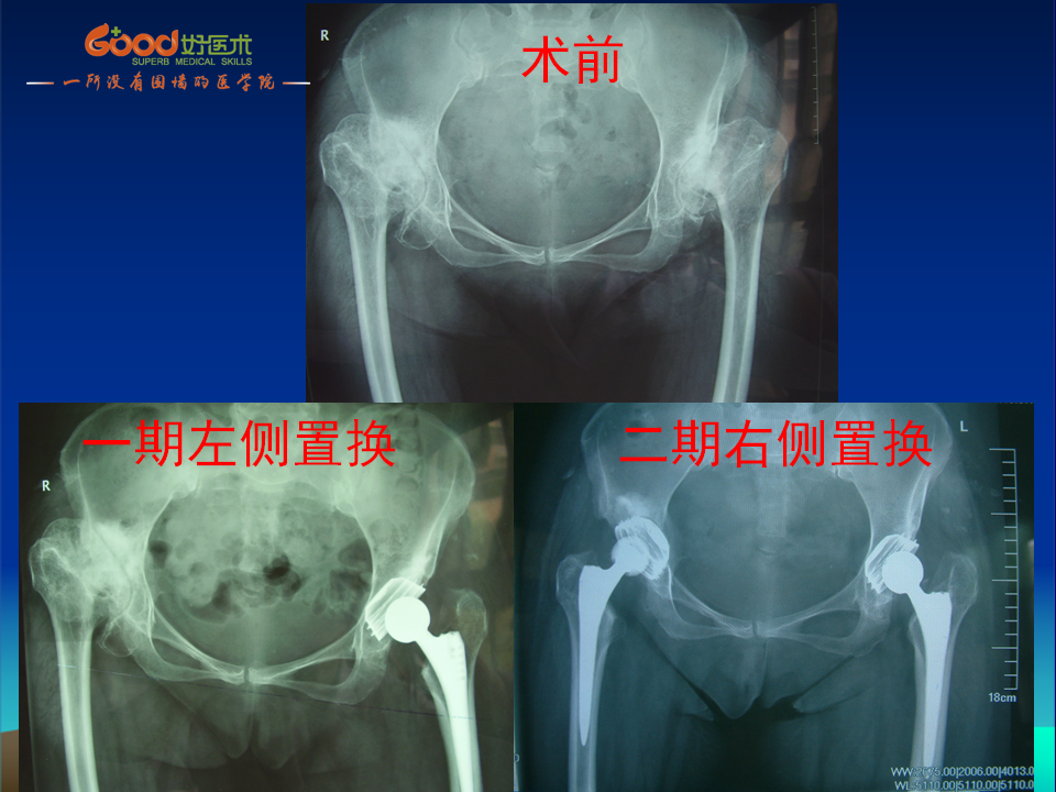 髋臼发育不良(DDH)手术策略