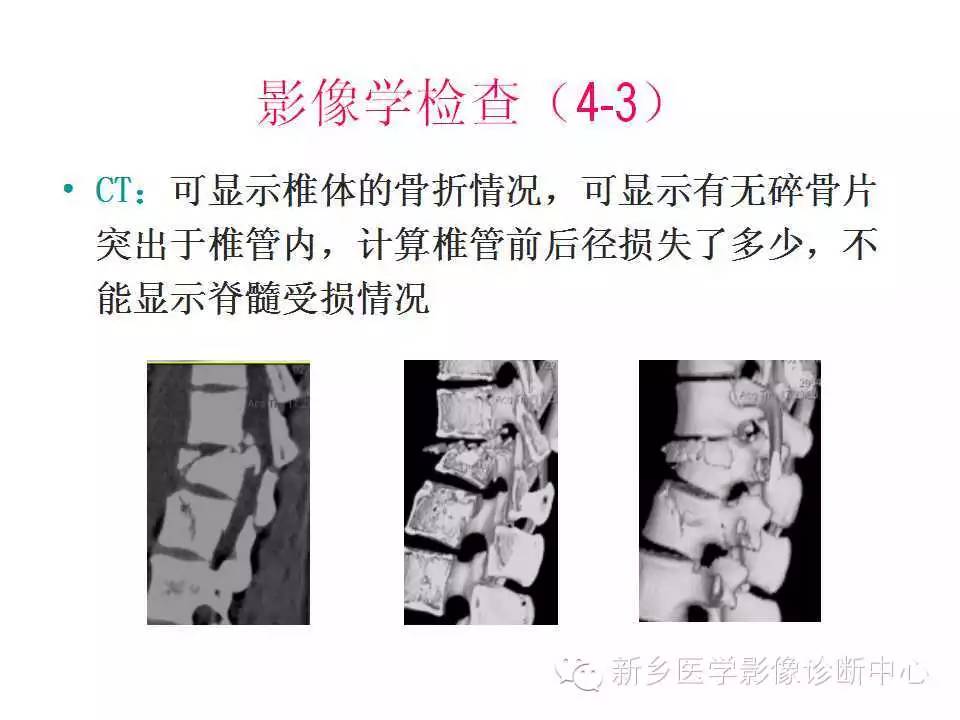脊柱骨折的详细分型及治疗