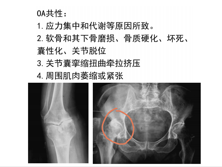 内翻膝OA—数字矫形