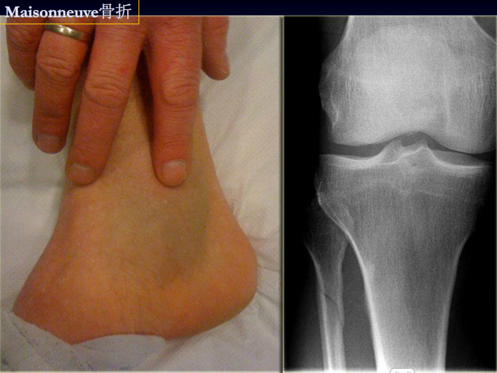 踝关节骨折：不那么明显的骨折