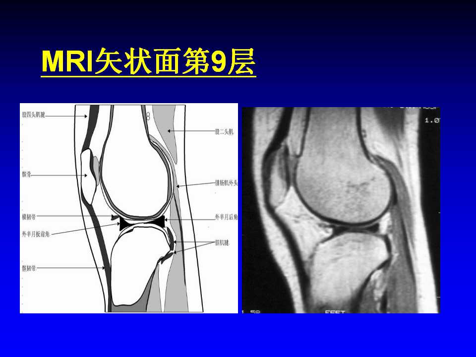 膝关节MRI如何诊断？