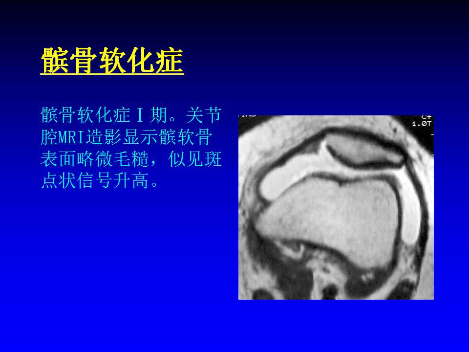 膝关节MRI如何诊断？