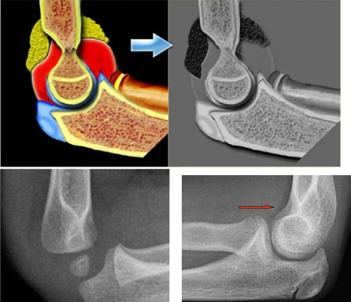 儿童肘关节骨折如何诊断？
