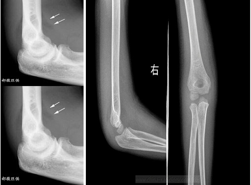 儿童肘关节骨折如何诊断？