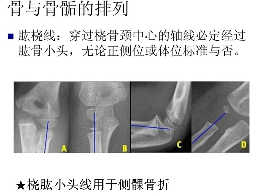 儿童肘关节骨折如何诊断？