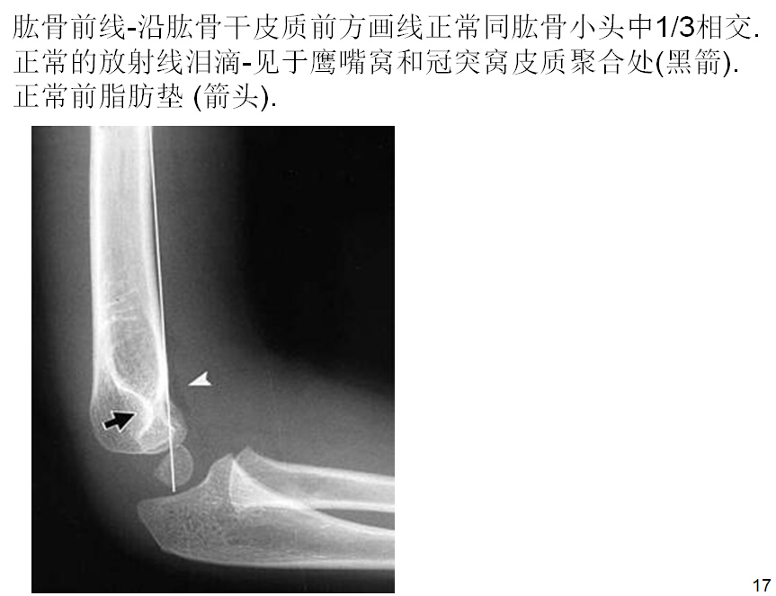 儿童肘关节骨折如何诊断？