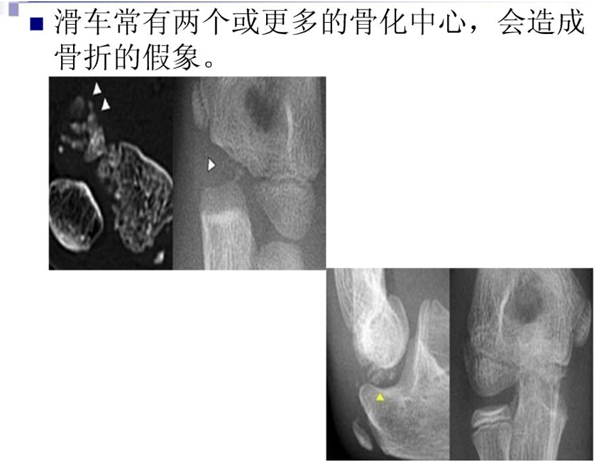 儿童肘关节骨折如何诊断？