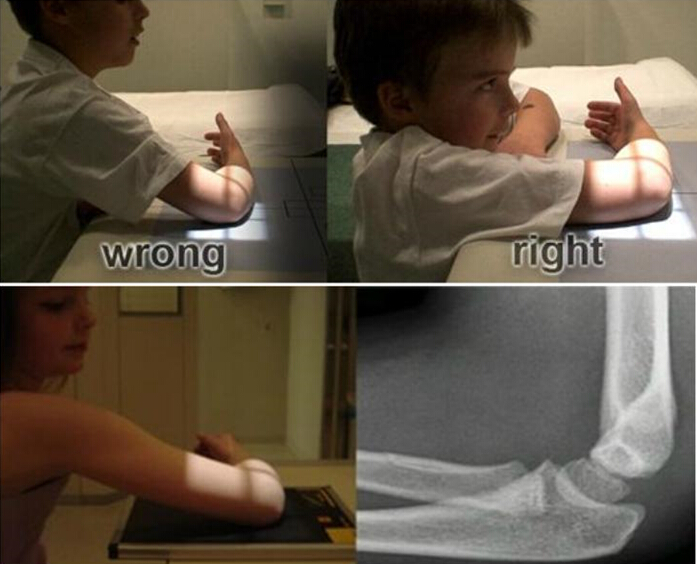 儿童肘关节骨折如何诊断？