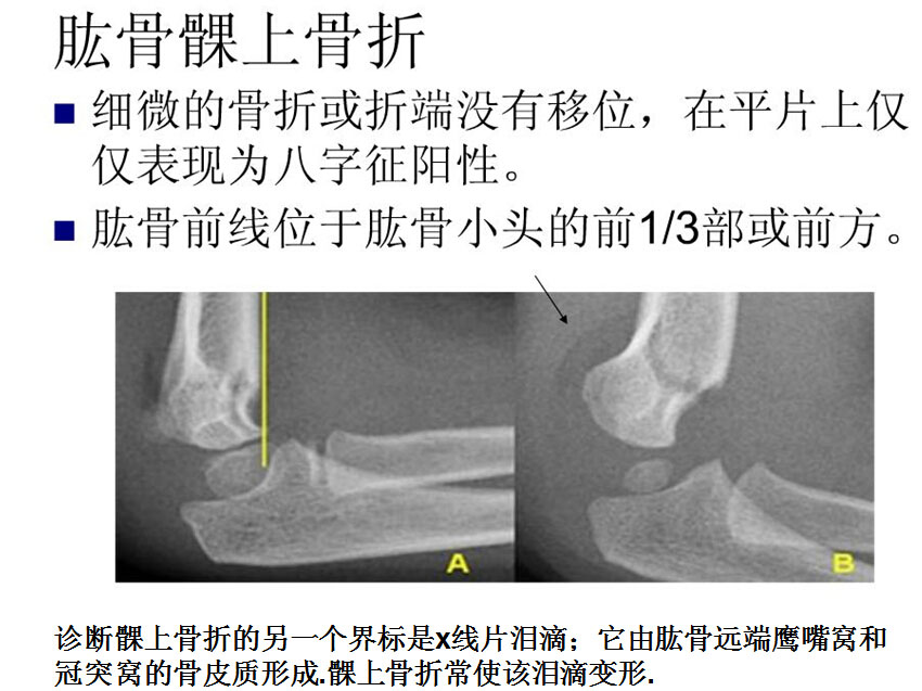 儿童肘关节骨折如何诊断？