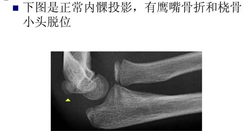 儿童肘关节骨折如何诊断？