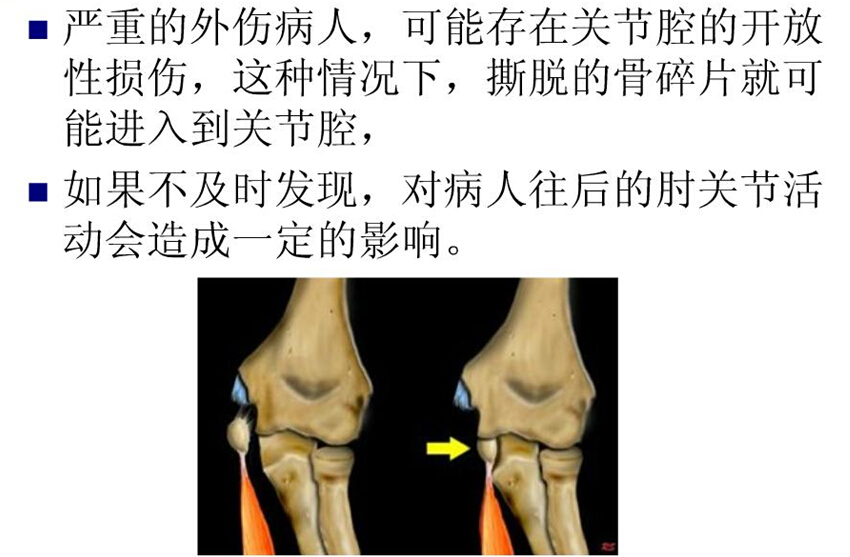 儿童肘关节骨折如何诊断？