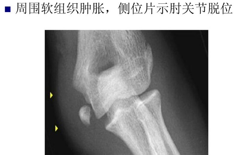 儿童肘关节骨折如何诊断？