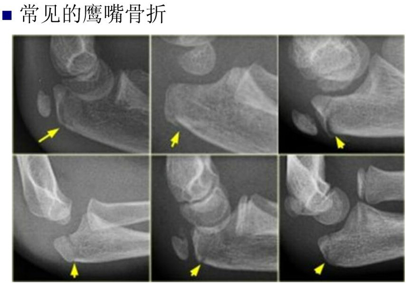 儿童肘关节骨折如何诊断？