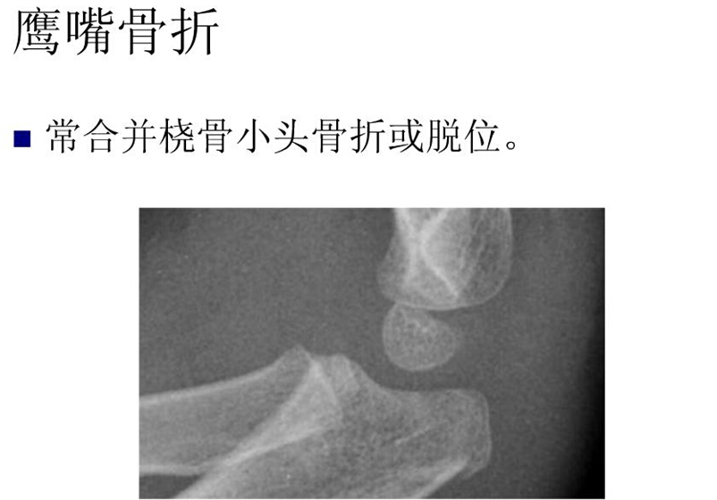 儿童肘关节骨折如何诊断？