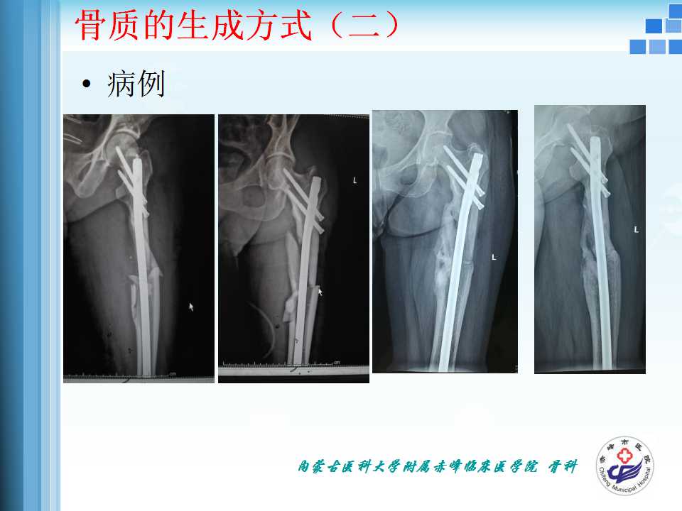 骨折愈合的原理与逻辑