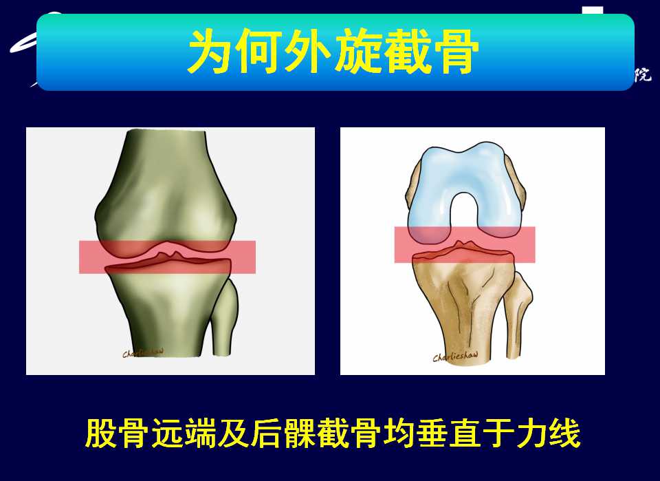 全膝关节置换术怎么截骨？