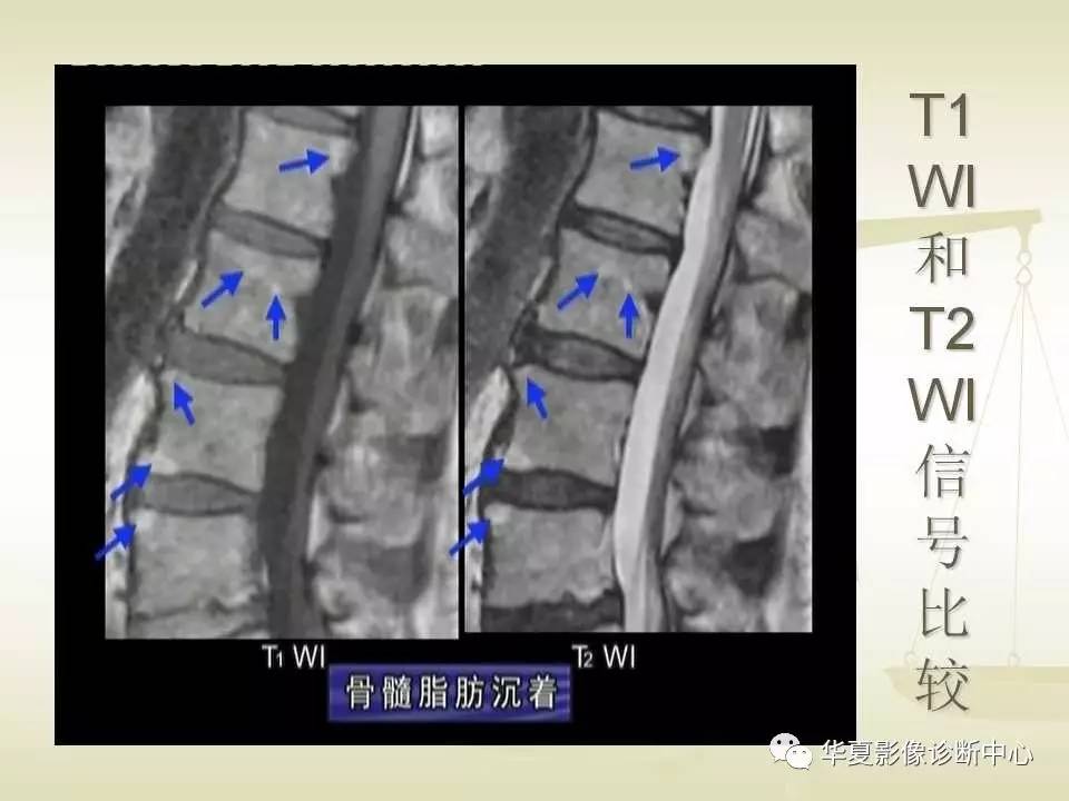 22种骨关节基本病变的MRI表现