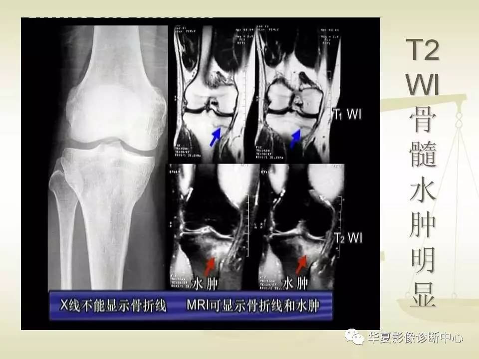 22种骨关节基本病变的MRI表现