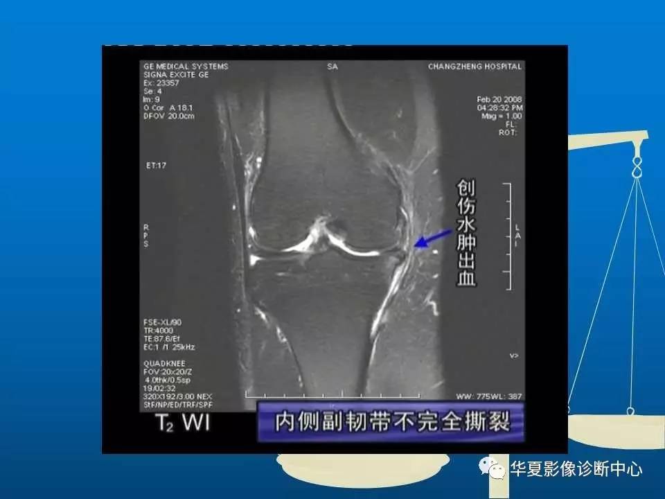 22种骨关节基本病变的MRI表现