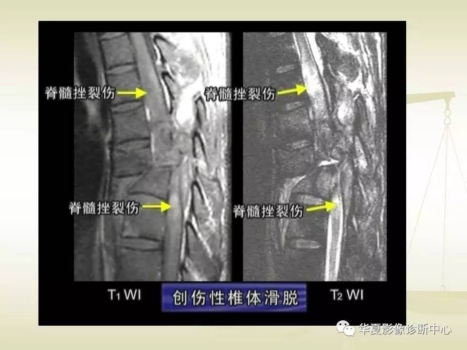 22种骨关节基本病变的MRI表现