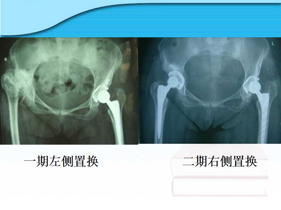 螺旋臼介绍及其在临床中的应用