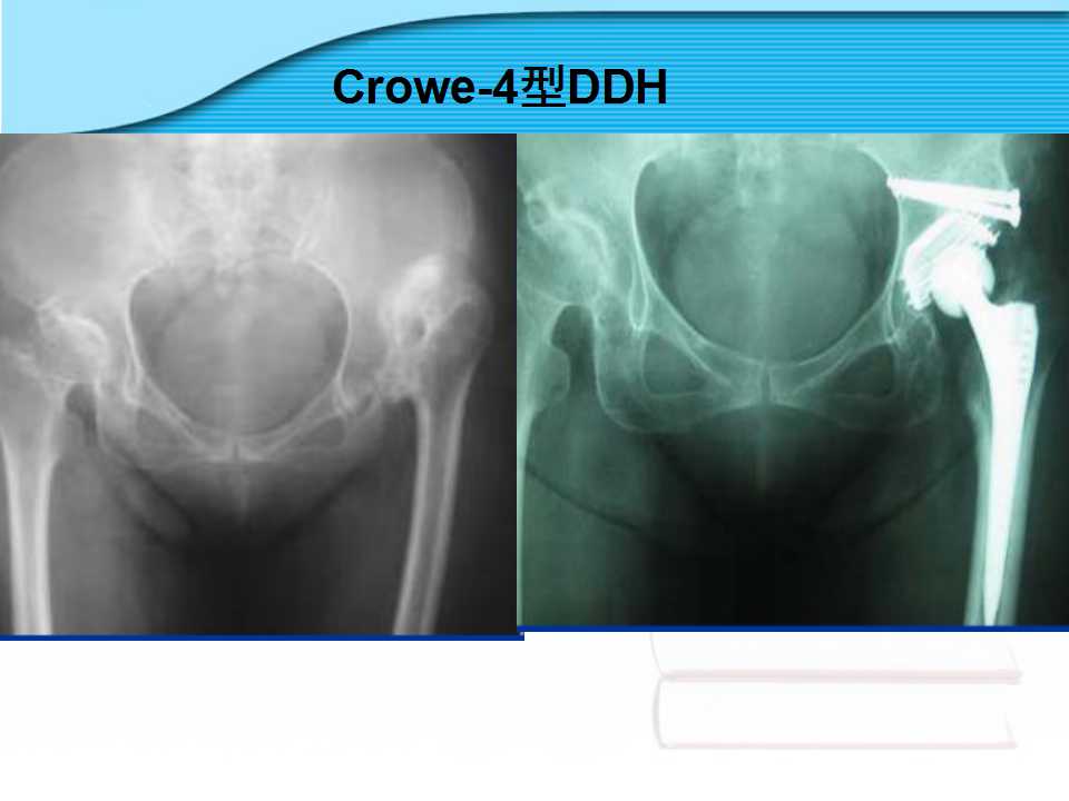 螺旋臼介绍及其在临床中的应用