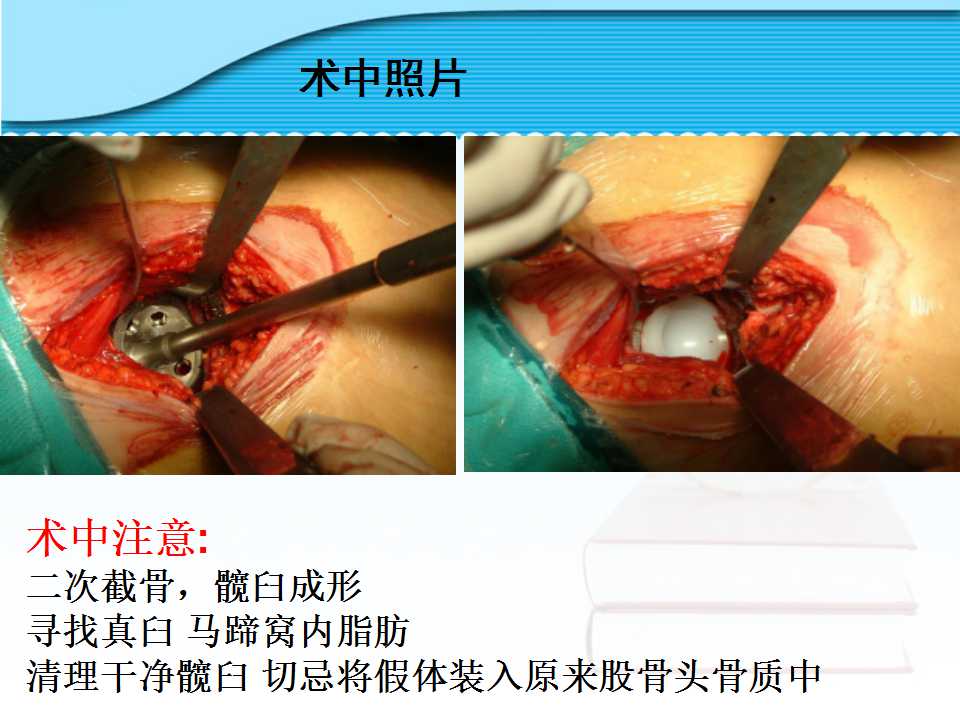 螺旋臼介绍及其在临床中的应用