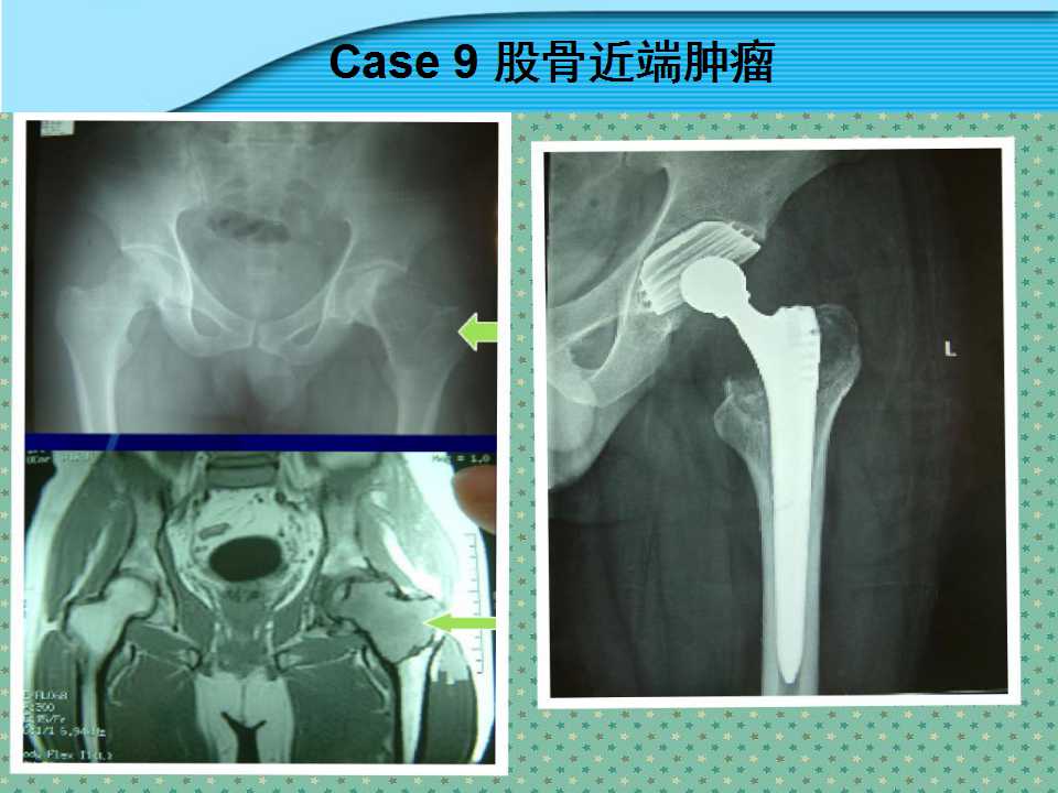 螺旋臼介绍及其在临床中的应用