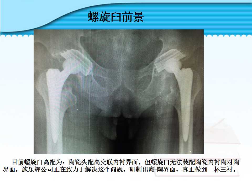 螺旋臼介绍及其在临床中的应用