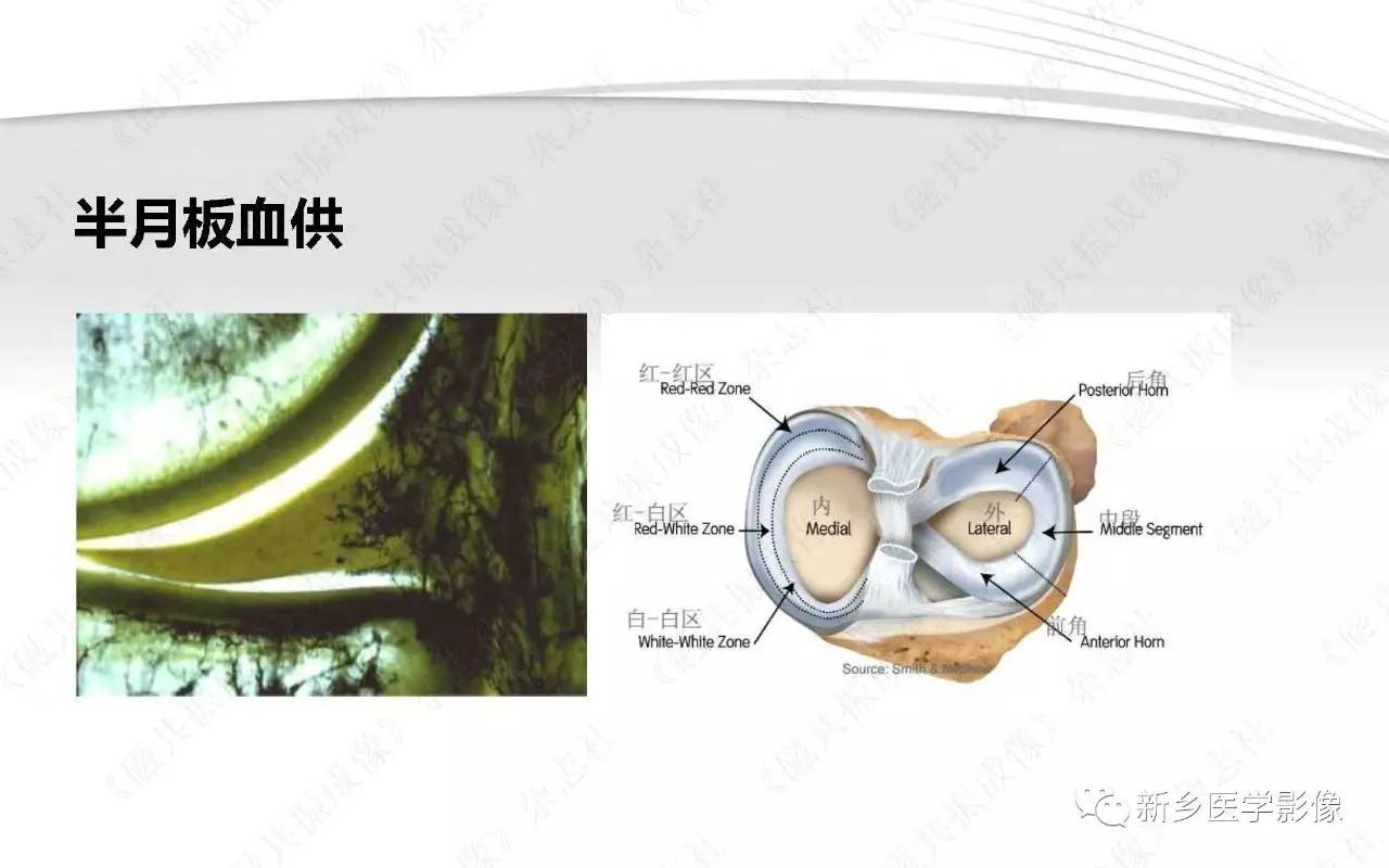 半月板损伤手术前后的MRI诊断