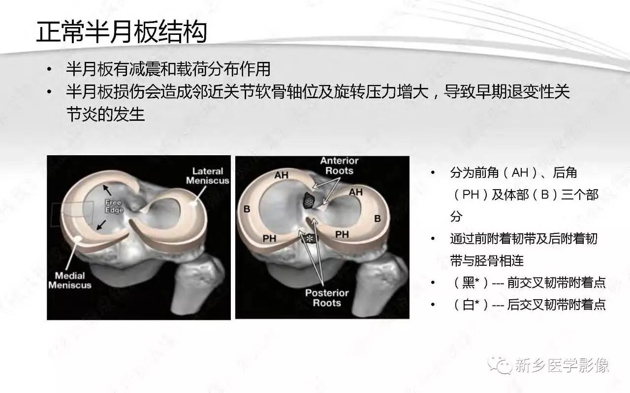 半月板损伤手术前后的MRI诊断