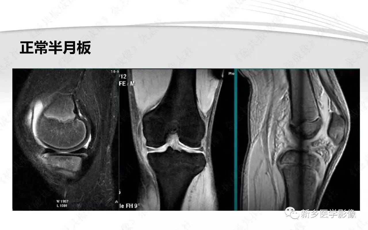 半月板损伤手术前后的MRI诊断