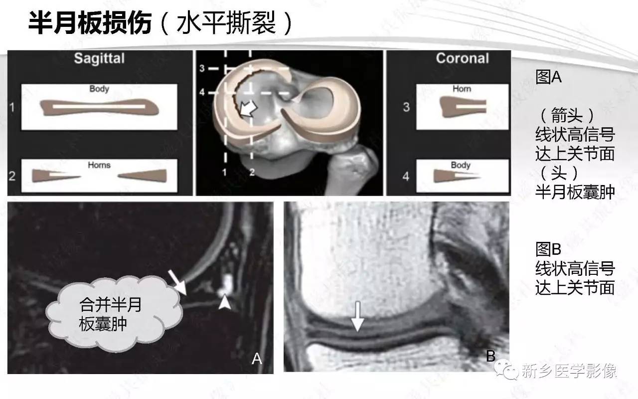 半月板损伤手术前后的MRI诊断