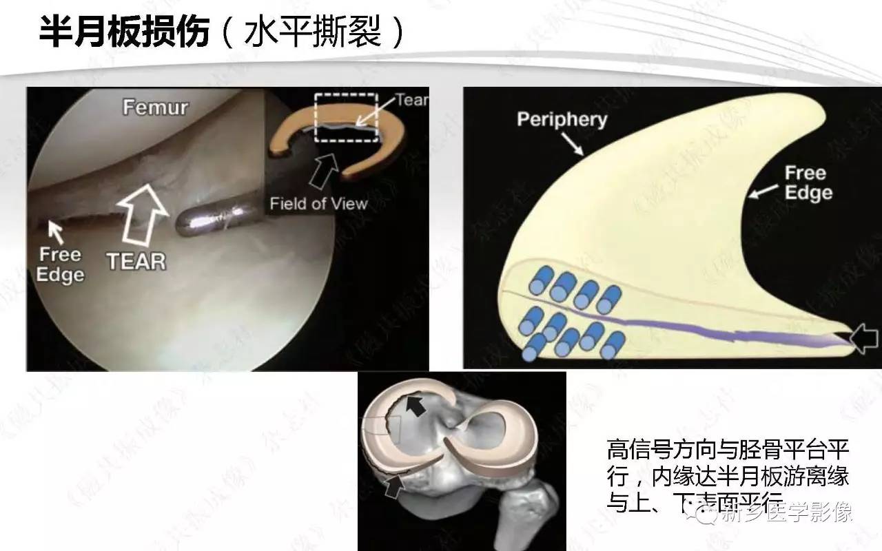 半月板损伤手术前后的MRI诊断