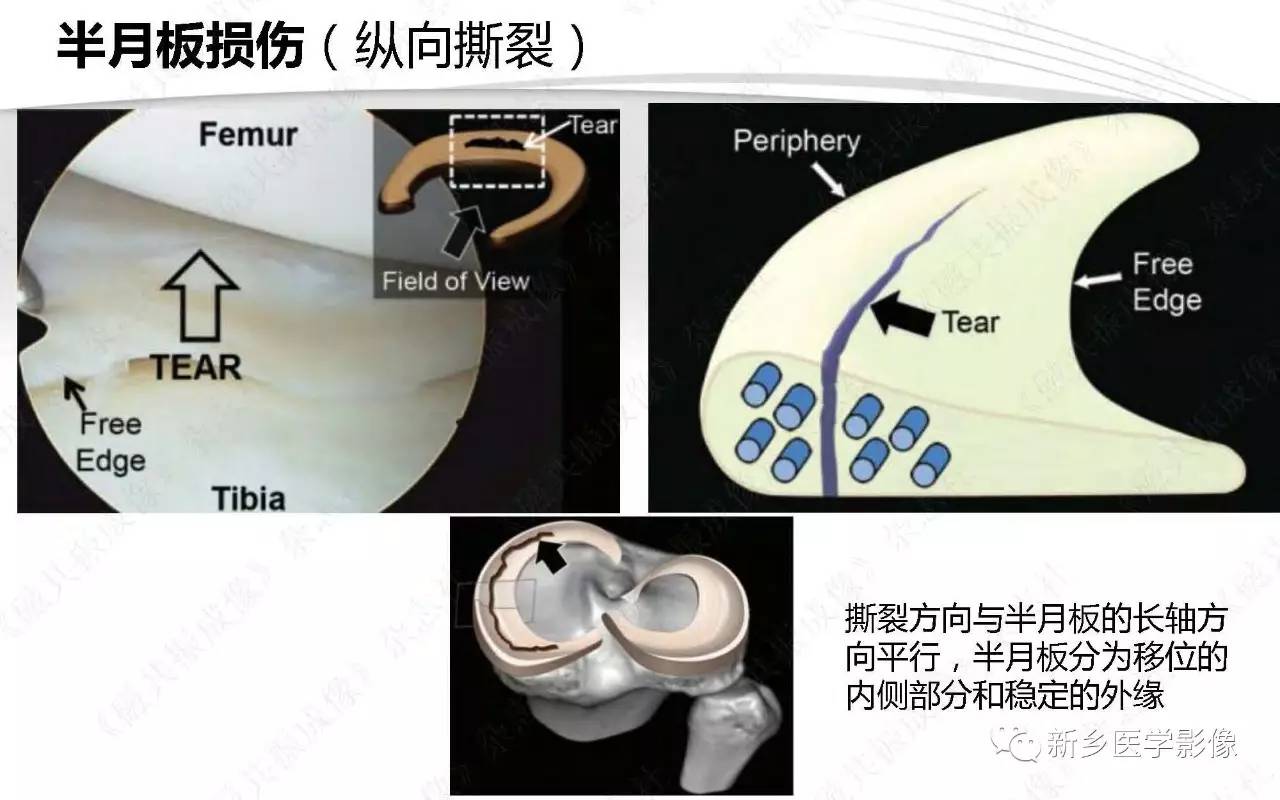 半月板损伤手术前后的MRI诊断