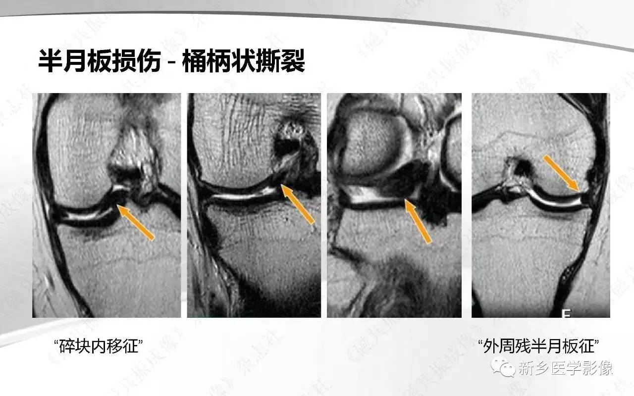 半月板损伤手术前后的MRI诊断