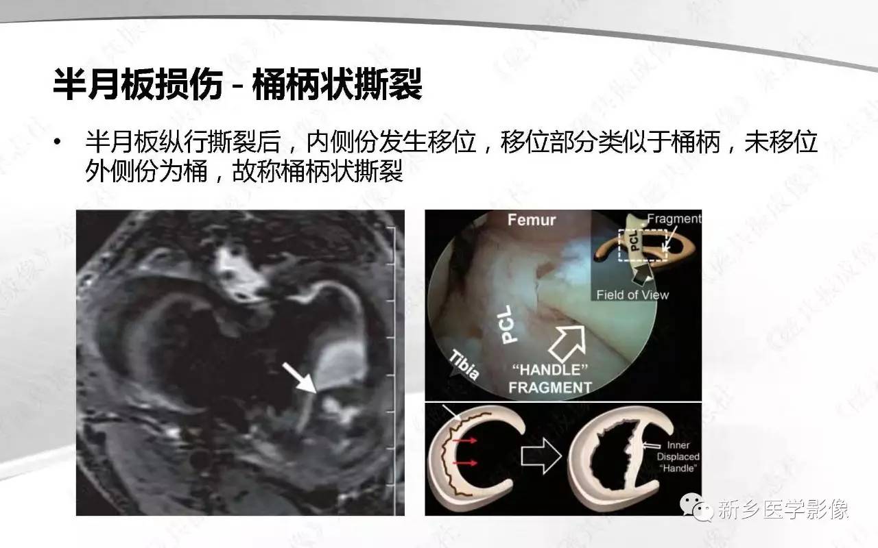 半月板损伤手术前后的MRI诊断