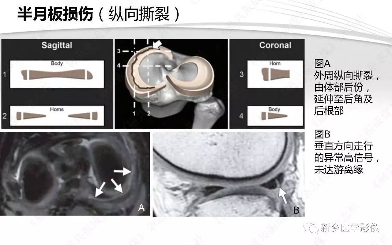 半月板损伤手术前后的MRI诊断