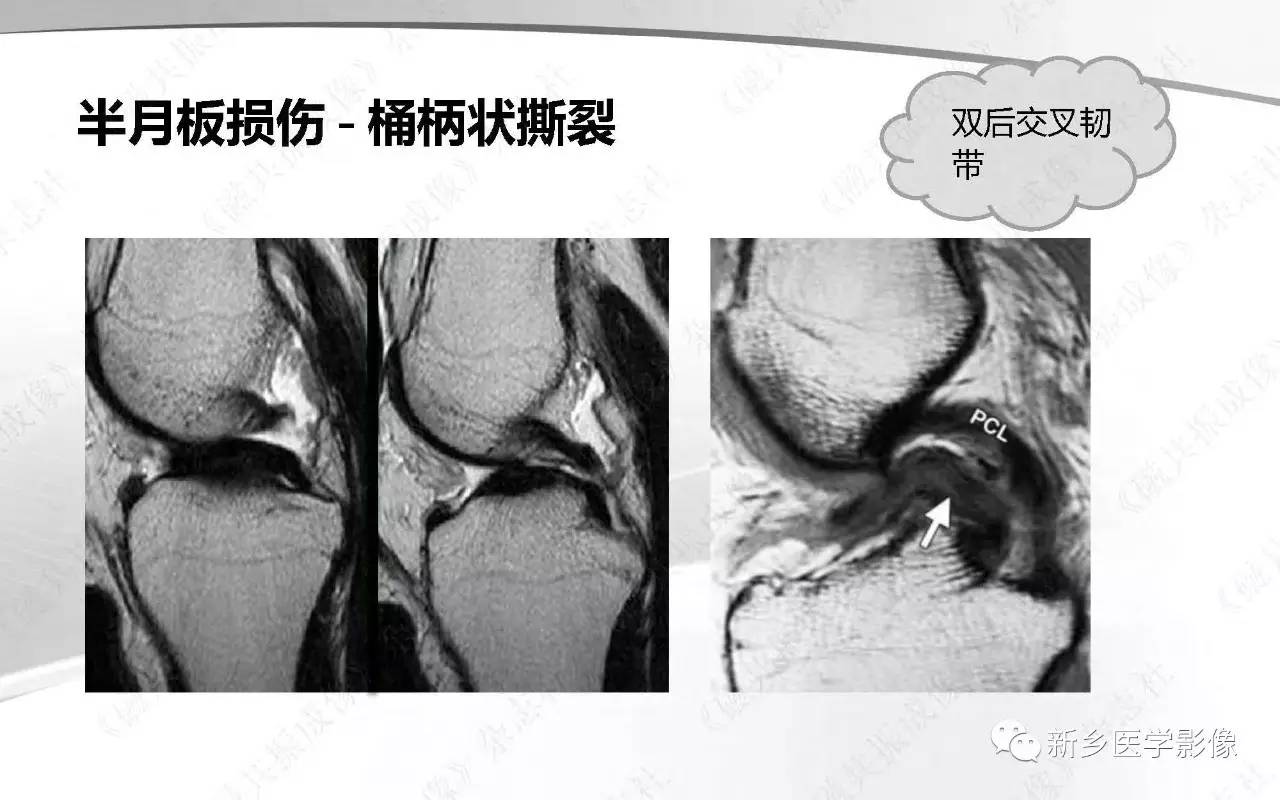 半月板损伤手术前后的MRI诊断