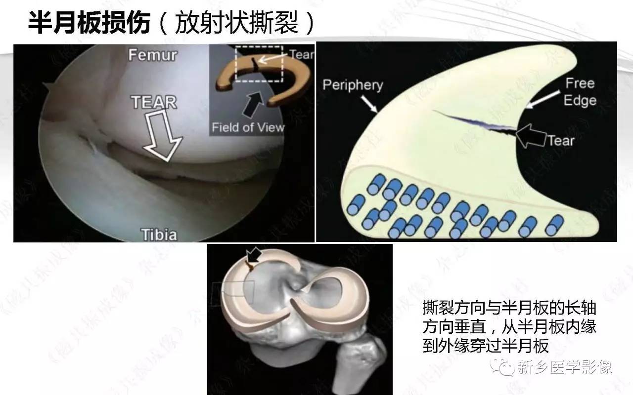 半月板损伤手术前后的MRI诊断