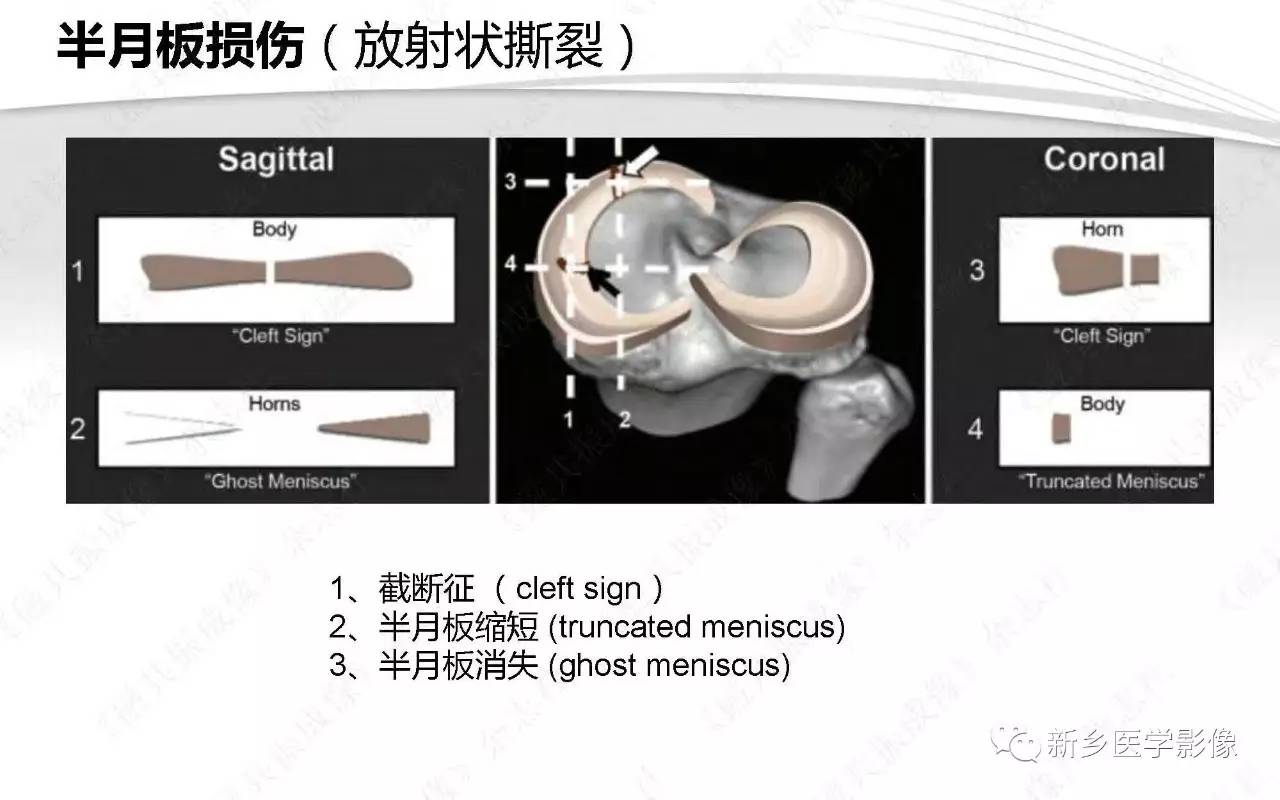 半月板损伤手术前后的MRI诊断