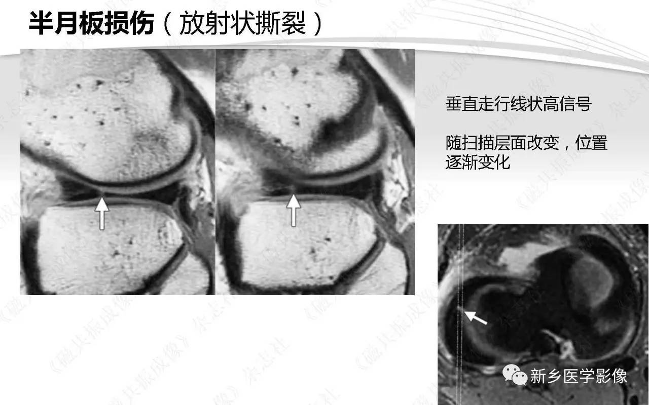 半月板损伤手术前后的MRI诊断