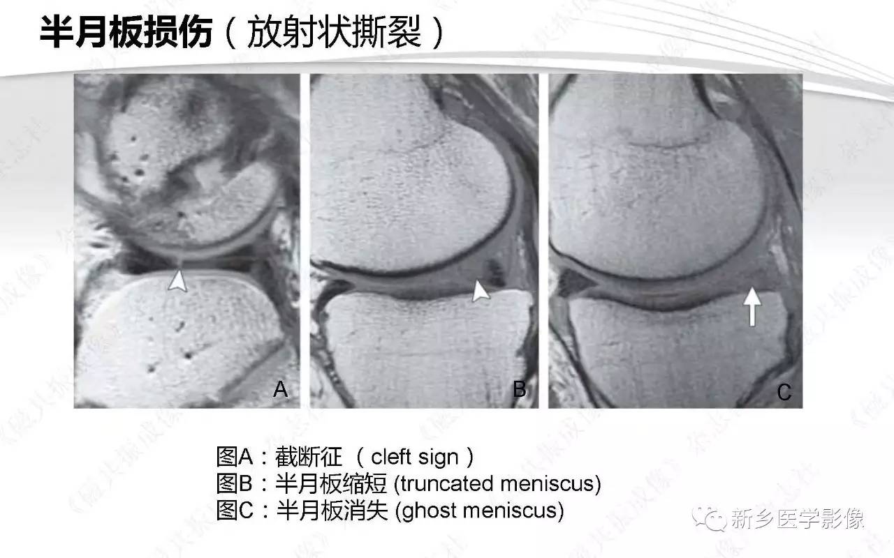 半月板损伤手术前后的MRI诊断