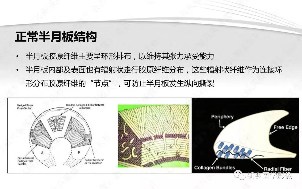 半月板损伤手术前后的MRI诊断