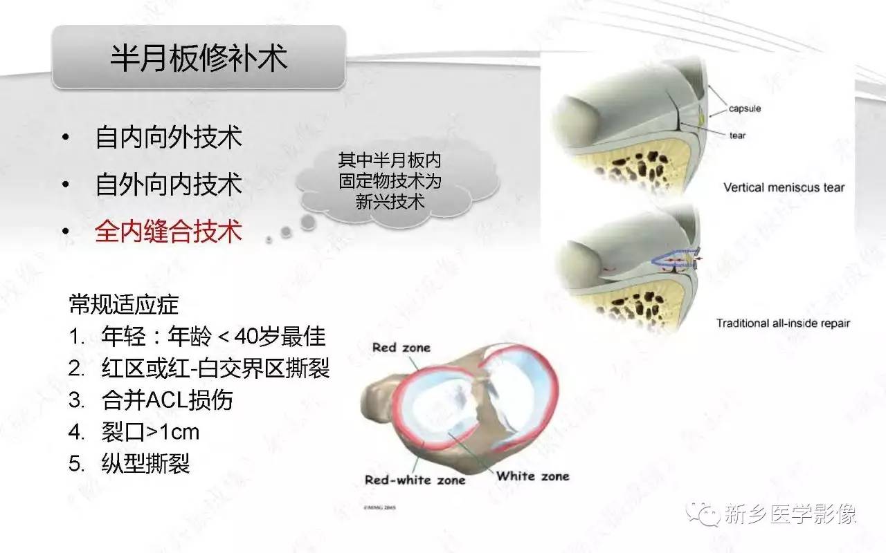 半月板损伤手术前后的MRI诊断