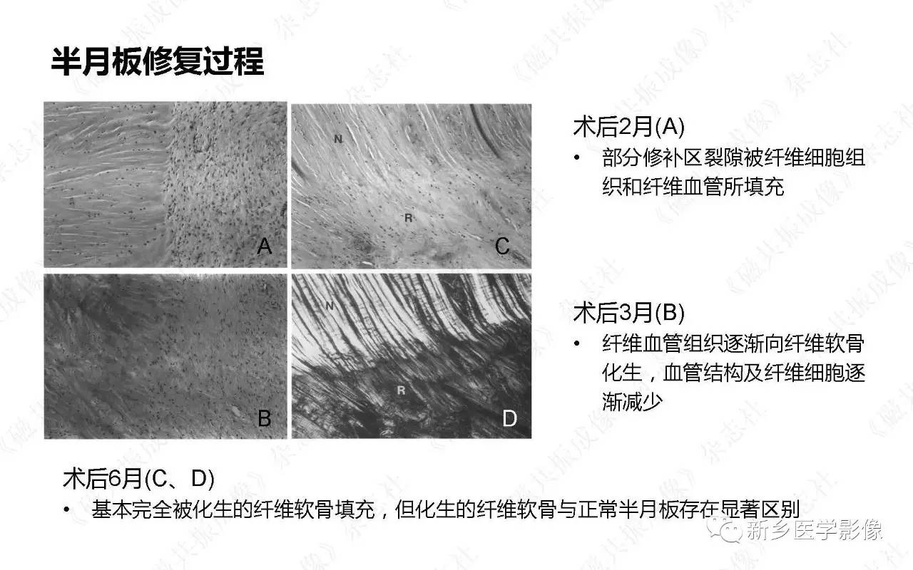 半月板损伤手术前后的MRI诊断