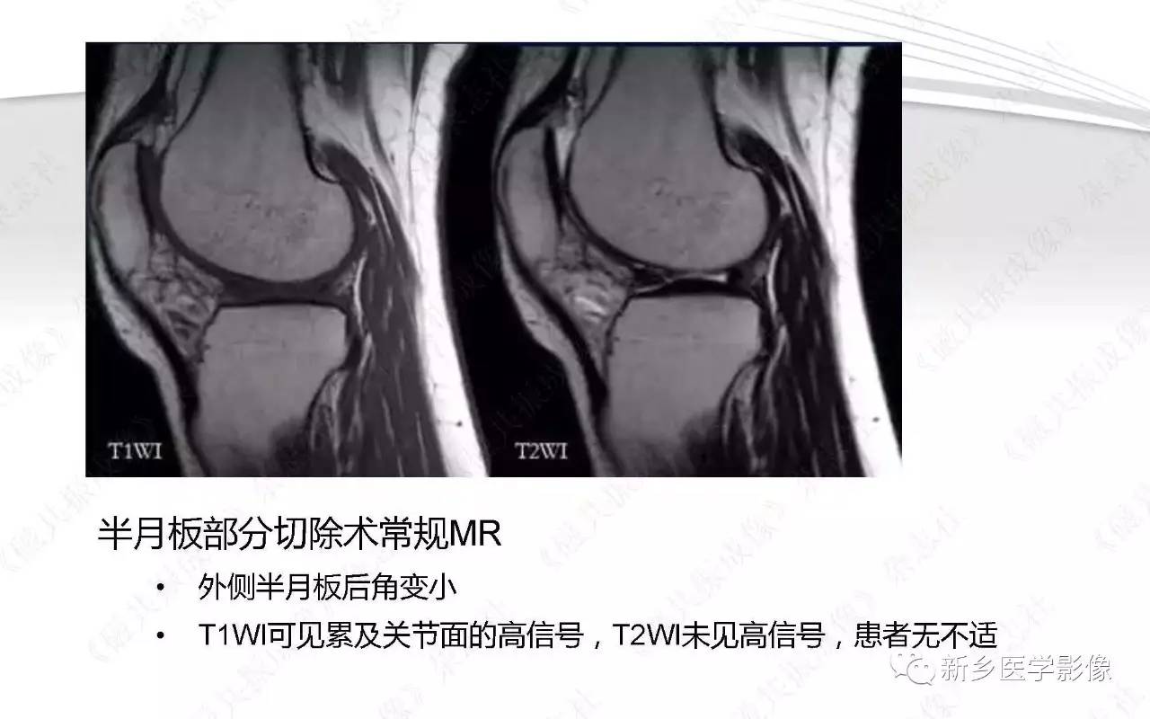 半月板损伤手术前后的MRI诊断