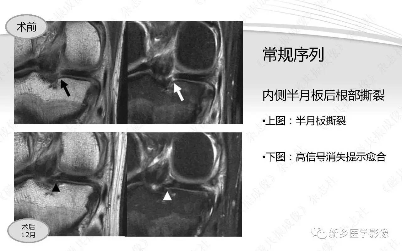 半月板损伤手术前后的MRI诊断